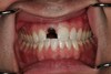 Dental Implants in Costa Mesa